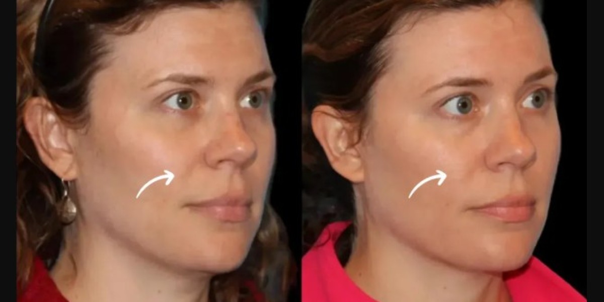 Sculptra Fillers Treatment in Dubai – Preventive Aesthetics for 20‑Somethings